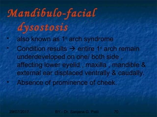 29/07/2017 BY - Dr. Sanjana G. Patil 70
Mandibulo-facial
dysostosis
 also known as 1st
arch syndrome
 Condition results  entire 1st
arch remain
underdeveloped on one/ both side ,
affecting lower eyelid , maxilla , mandible &
external ear displaced ventrally & caudally.
 Absence of prominence of cheek.
 