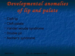 29/07/2017 BY - Dr. Sanjana G. Patil 71
Developmental anomalies
of lip and palate
 Cleft lip
 Cleft palate
 Vander woude syndrome
 Double pit
 Ascher’s syndrome
 