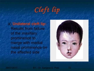 29/07/2017 BY - Dr. Sanjana G. Patil 72
Cleft lip
a) Unilateral cleft lip:
Results from failure
of the maxillary
prominence to
merge with medial
nasal prominence on
the affected side
 