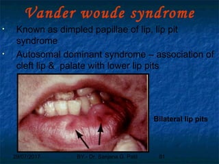29/07/2017 BY - Dr. Sanjana G. Patil 81
Vander woude syndrome
• Known as dimpled papillae of lip, lip pit
syndrome
• Autosomal dominant syndrome – association of
cleft lip & palate with lower lip pits
Bilateral lip pits
 