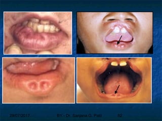 29/07/2017 BY - Dr. Sanjana G. Patil 82
 