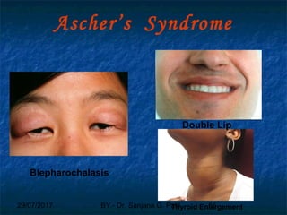 29/07/2017 BY - Dr. Sanjana G. Patil 85
Ascher’s Syndrome
Blepharochalasis
Double Lip
Thyroid Enlargement
 