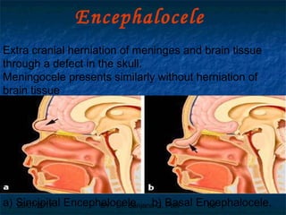 29/07/2017 BY - Dr. Sanjana G. Patil 88
Encephalocele
Extra cranial herniation of meninges and brain tissue
through a defect in the skull.
Meningocele presents similarly without herniation of
brain tissue
a) Sincipital Encephalocele b) Basal Encephalocele.
 