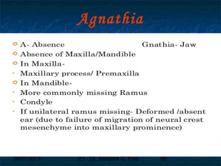 29/07/2017 BY - Dr. Sanjana G. Patil 98
Agnathia
 