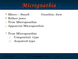 29/07/2017 BY - Dr. Sanjana G. Patil 99
Micrognathia
 
