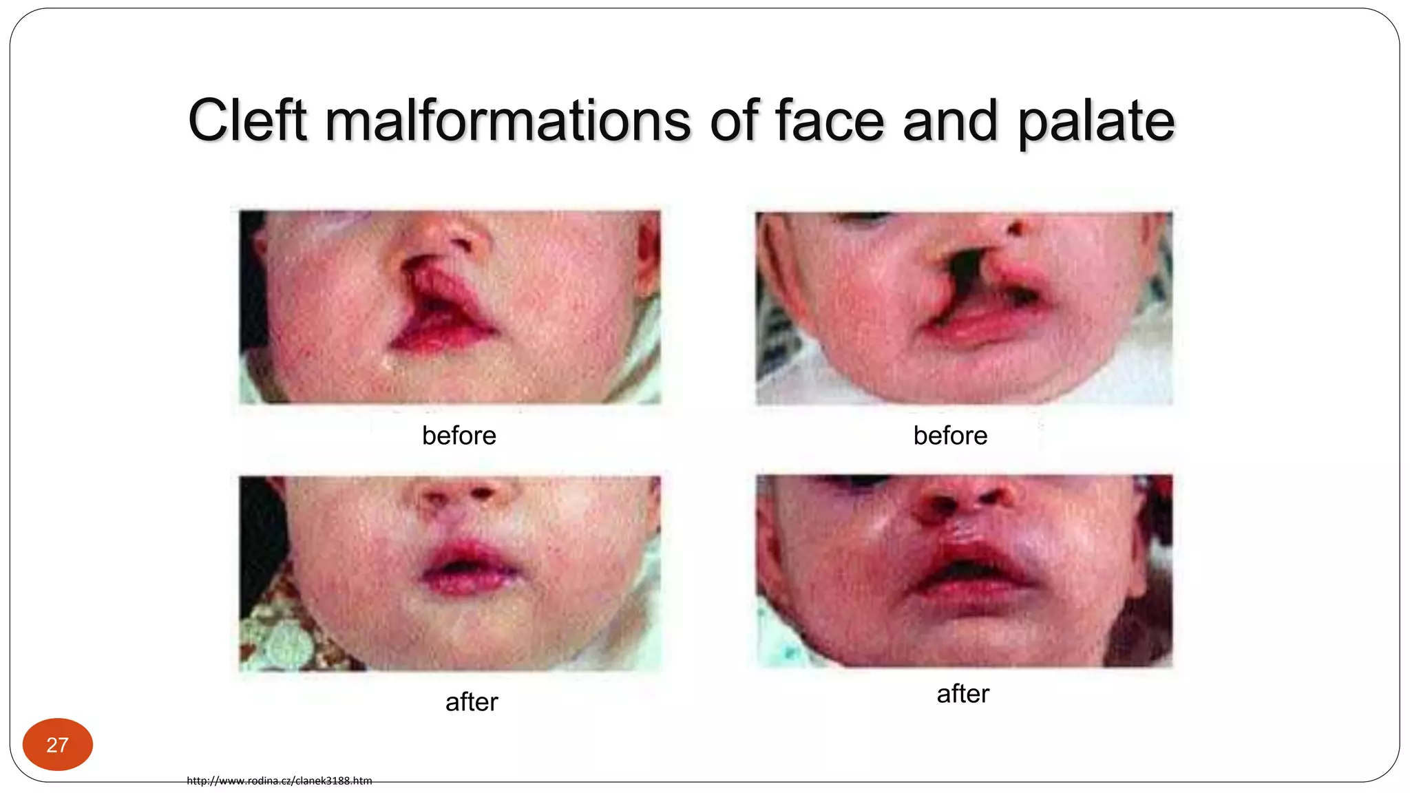 development of the face and palate.pptx