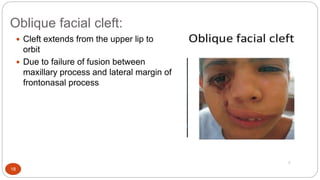 Oblique Facial Cleft