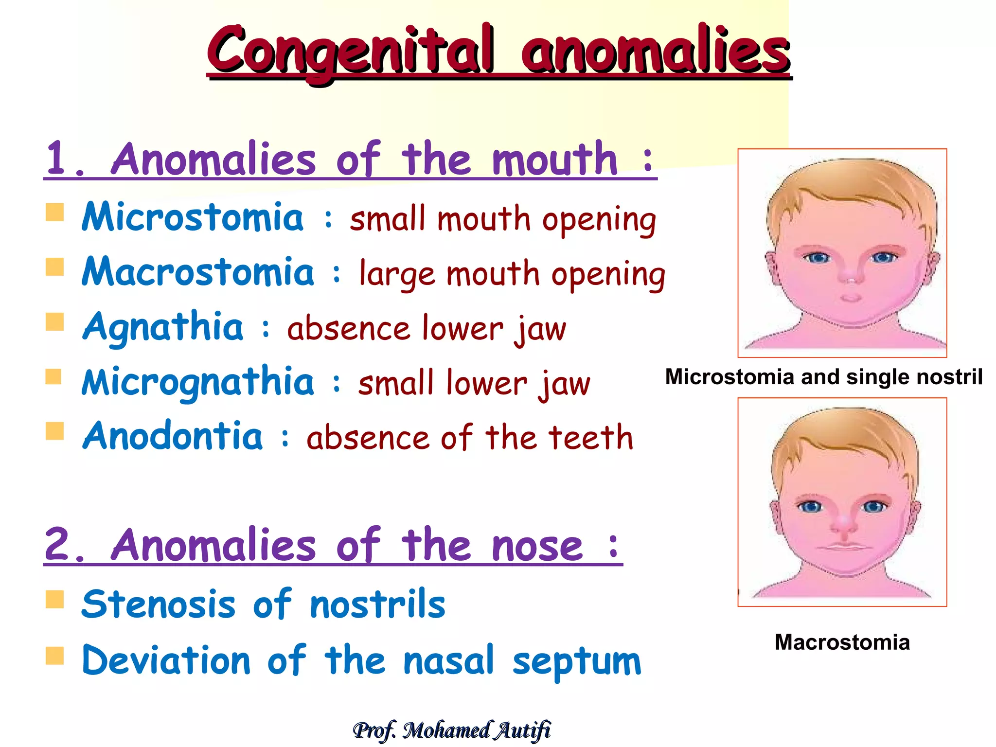Congenital anomalies
1. Anomalies of the mouth :







Microstomia : small mouth opening
Macrostomia : large mouth opening
Agnathia : absence lower jaw
Microstomia and single nostril
Micrognathia : small lower jaw
Anodontia : absence of the teeth

2. Anomalies of the nose :



Stenosis of nostrils
Deviation of the nasal septum
Prof. Mohamed Autifi

Macrostomia

 