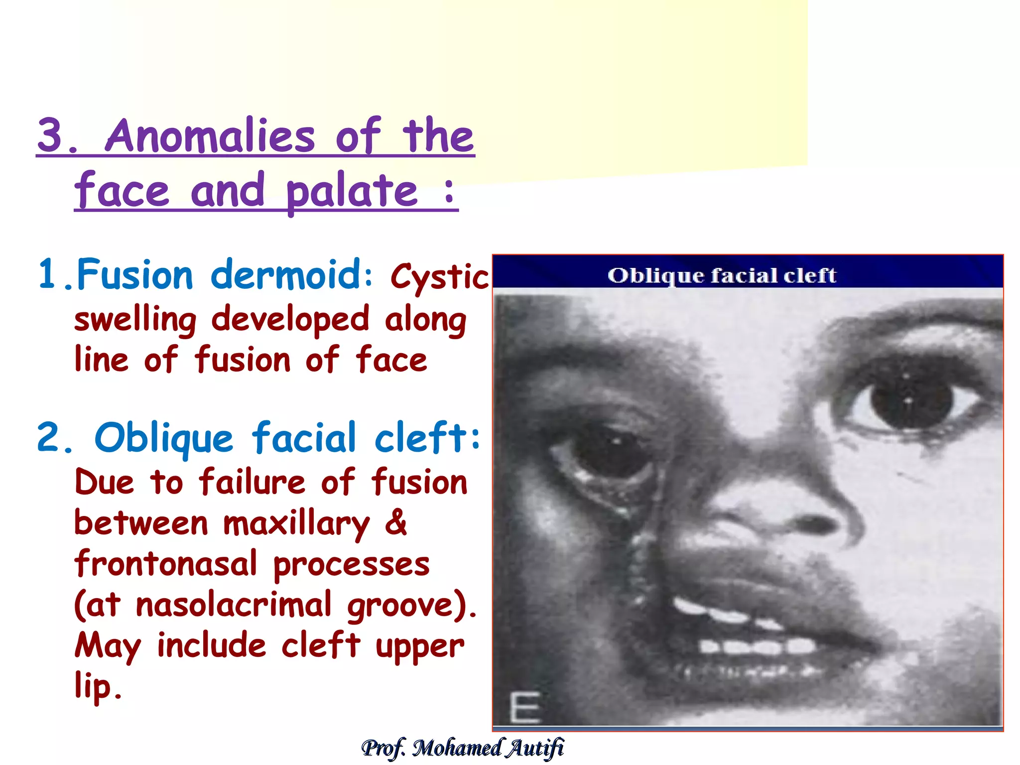 3. Anomalies of the
face and palate :
1.Fusion dermoid: Cystic
swelling developed along
line of fusion of face

2. Oblique facial cleft:
Due to failure of fusion
between maxillary &
frontonasal processes
(at nasolacrimal groove).
May include cleft upper
lip.

Prof. Mohamed Autifi

 