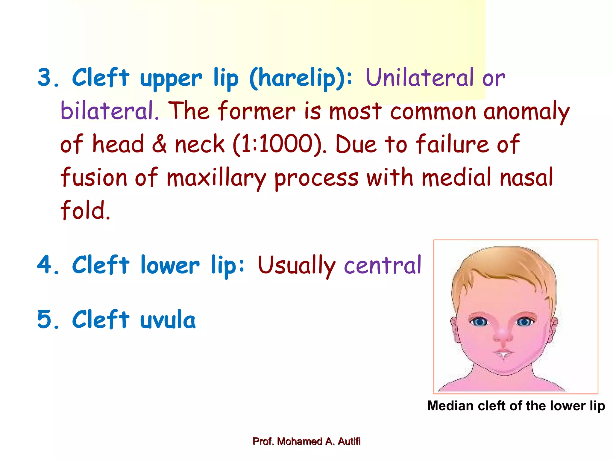 3. Cleft upper lip (harelip): Unilateral or
bilateral. The former is most common anomaly
of head & neck (1:1000). Due to failure of
fusion of maxillary process with medial nasal
fold.
4. Cleft lower lip: Usually central
5. Cleft uvula

Median cleft of the lower lip
Prof. Mohamed A. Autifi

 