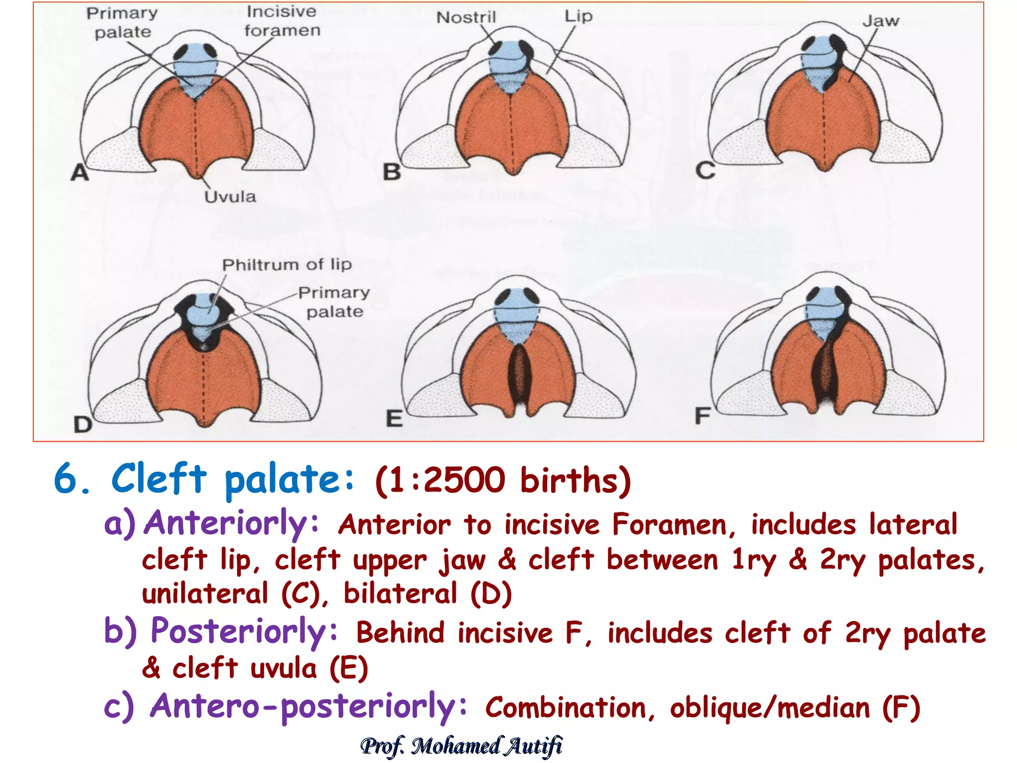 6. Cleft palate: (1:2500 births)

a) Anteriorly: Anterior to incisive Foramen, includes lateral

cleft lip, cleft upper jaw & cleft between 1ry & 2ry palates,
unilateral (C), bilateral (D)
b) Posteriorly: Behind incisive F, includes cleft of 2ry palate
& cleft uvula (E)
c) Antero-posteriorly: Combination, oblique/median (F)
Prof. Mohamed Autifi

 