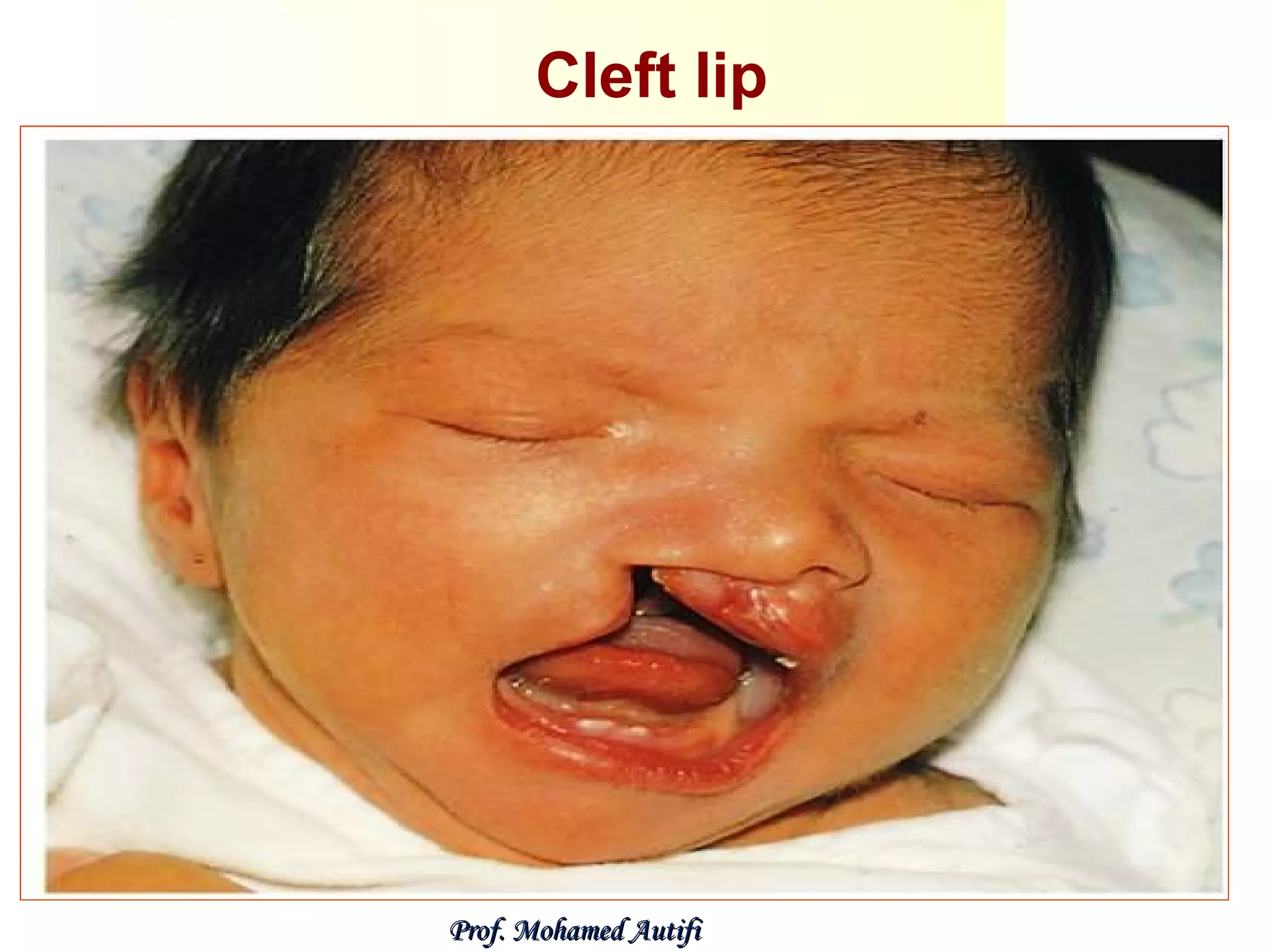 Cleft lip

Prof. Mohamed Autifi

 