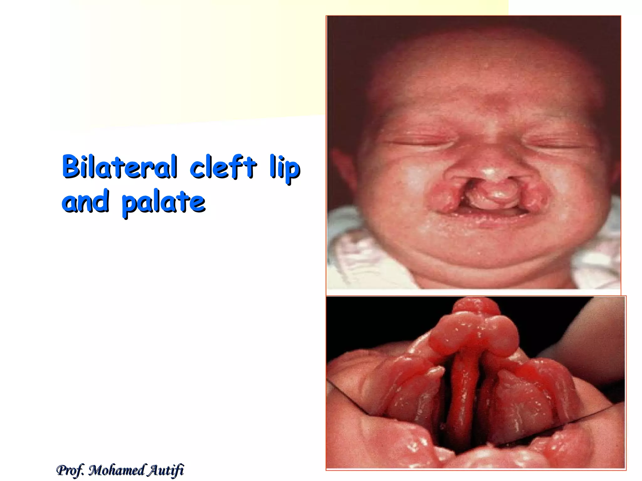 Bilateral cleft lip
and palate

Prof. Mohamed Autifi

 