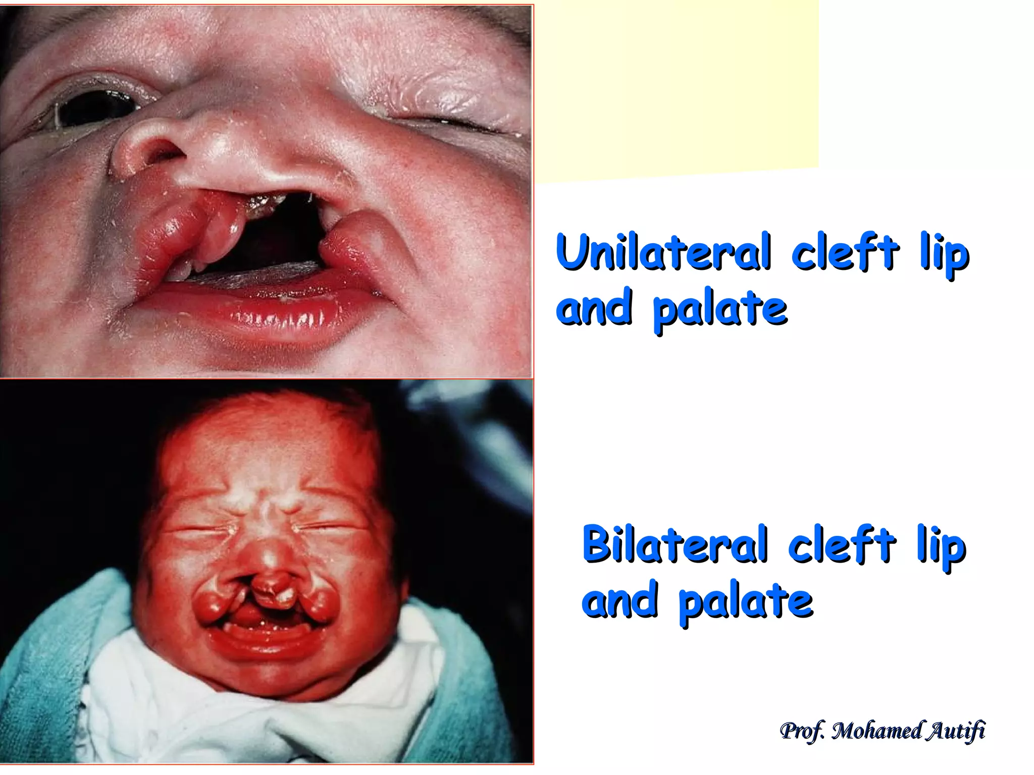 Unilateral cleft lip
and palate

Bilateral cleft lip
and palate
Prof. Mohamed Autifi

 