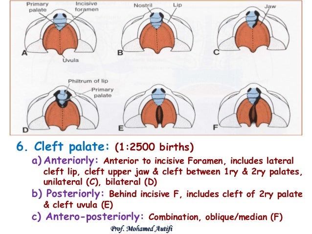 bilateral cleft lip