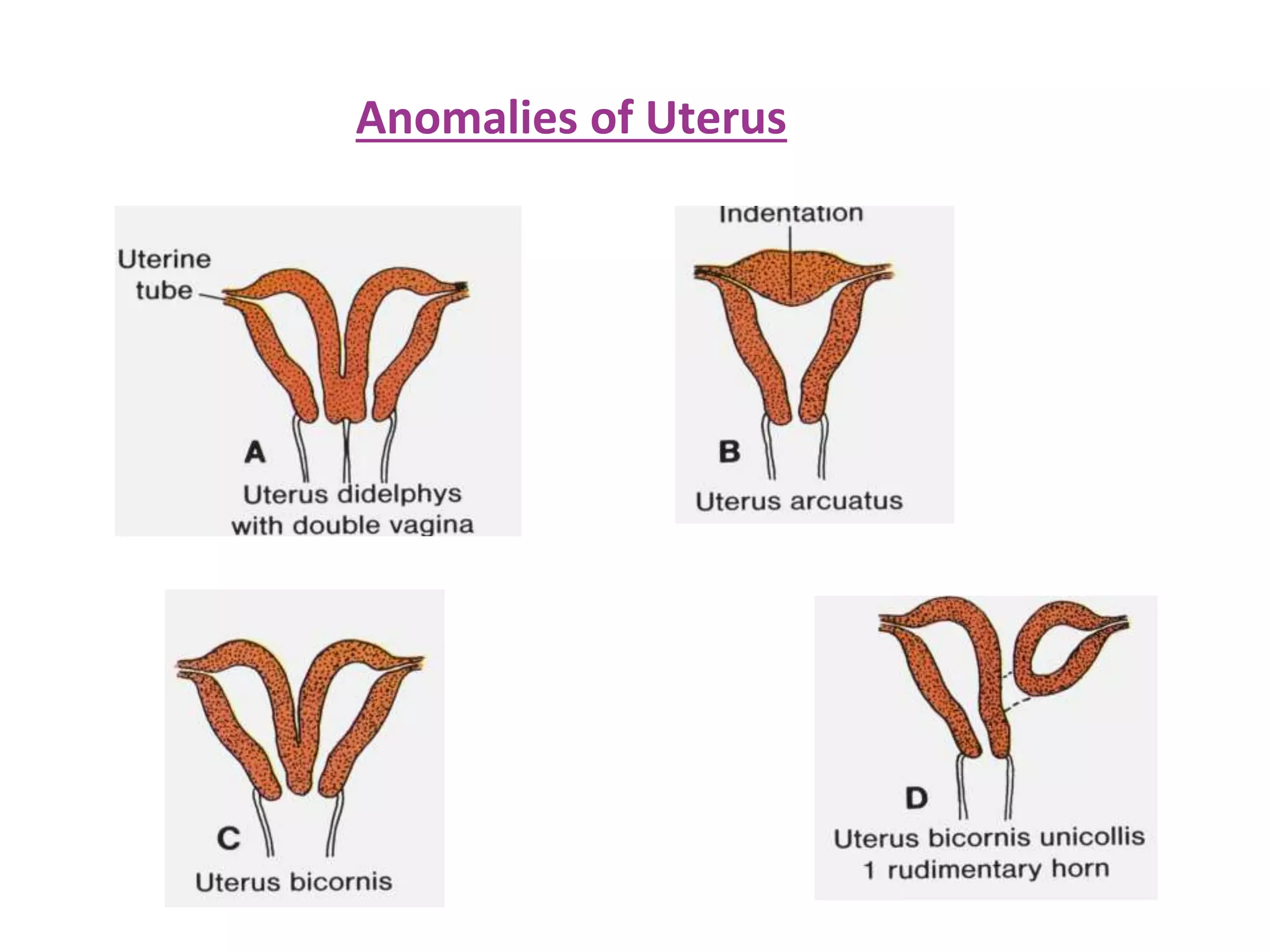 Anomalies of Uterus
 