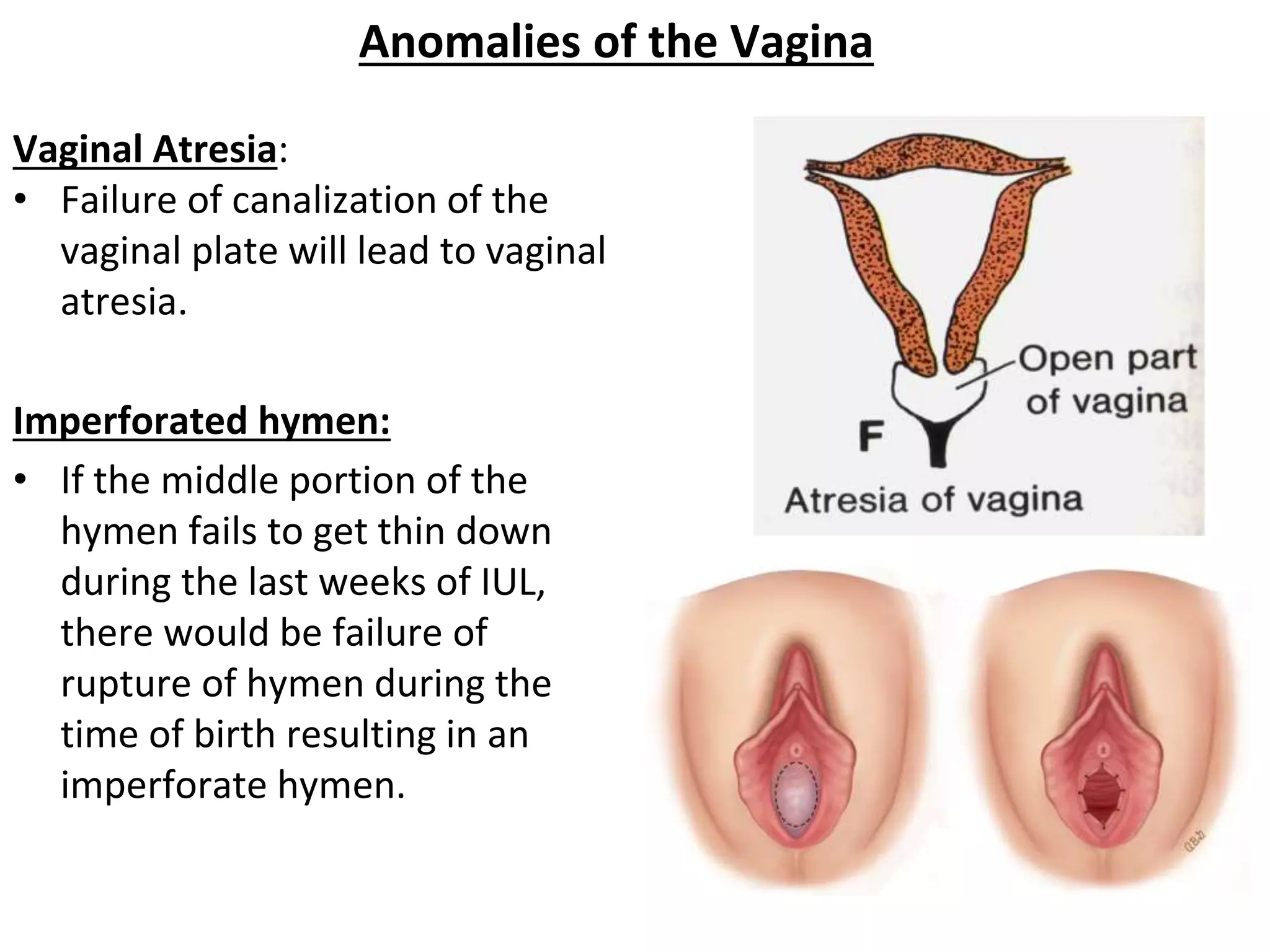 Anomalies of the Vagina
Vaginal Atresia:
• Failure of canalization of the
vaginal plate will lead to vaginal
atresia.
Imperforated hymen:
• If the middle portion of the
hymen fails to get thin down
during the last weeks of IUL,
there would be failure of
rupture of hymen during the
time of birth resulting in an
imperforate hymen.
 