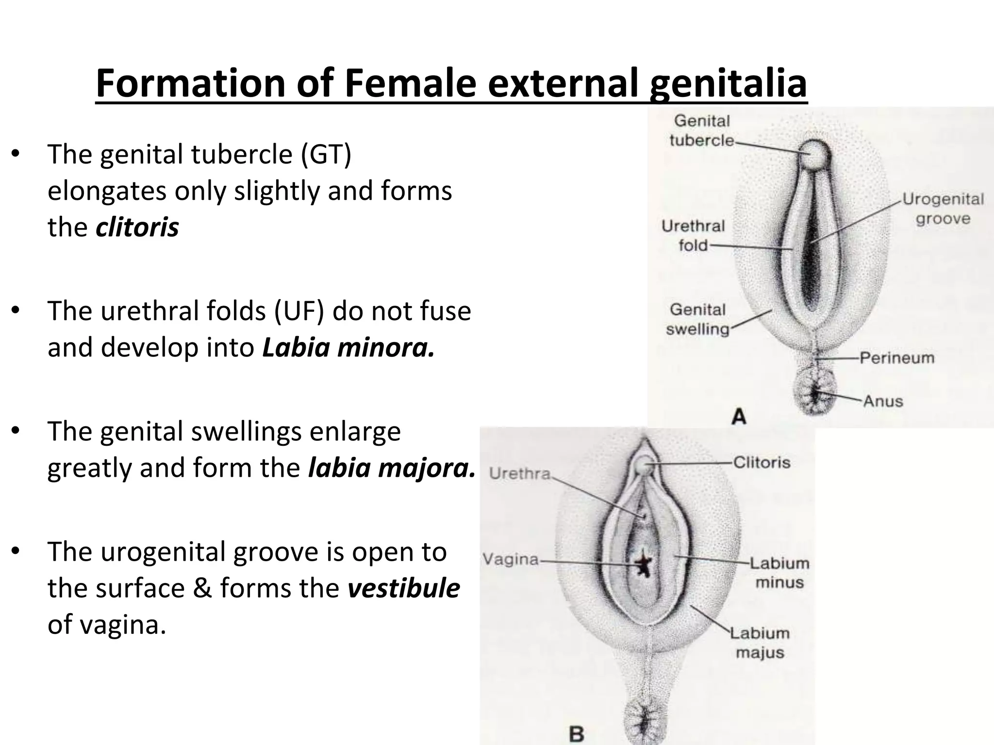 Formation of Female external genitalia
• The genital tubercle (GT)
elongates only slightly and forms
the clitoris
• The urethral folds (UF) do not fuse
and develop into Labia minora.
• The genital swellings enlarge
greatly and form the labia majora.
• The urogenital groove is open to
the surface & forms the vestibule
of vagina.
 