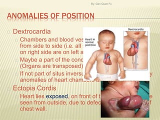 Transposed Organs Development of the heart | PPTX