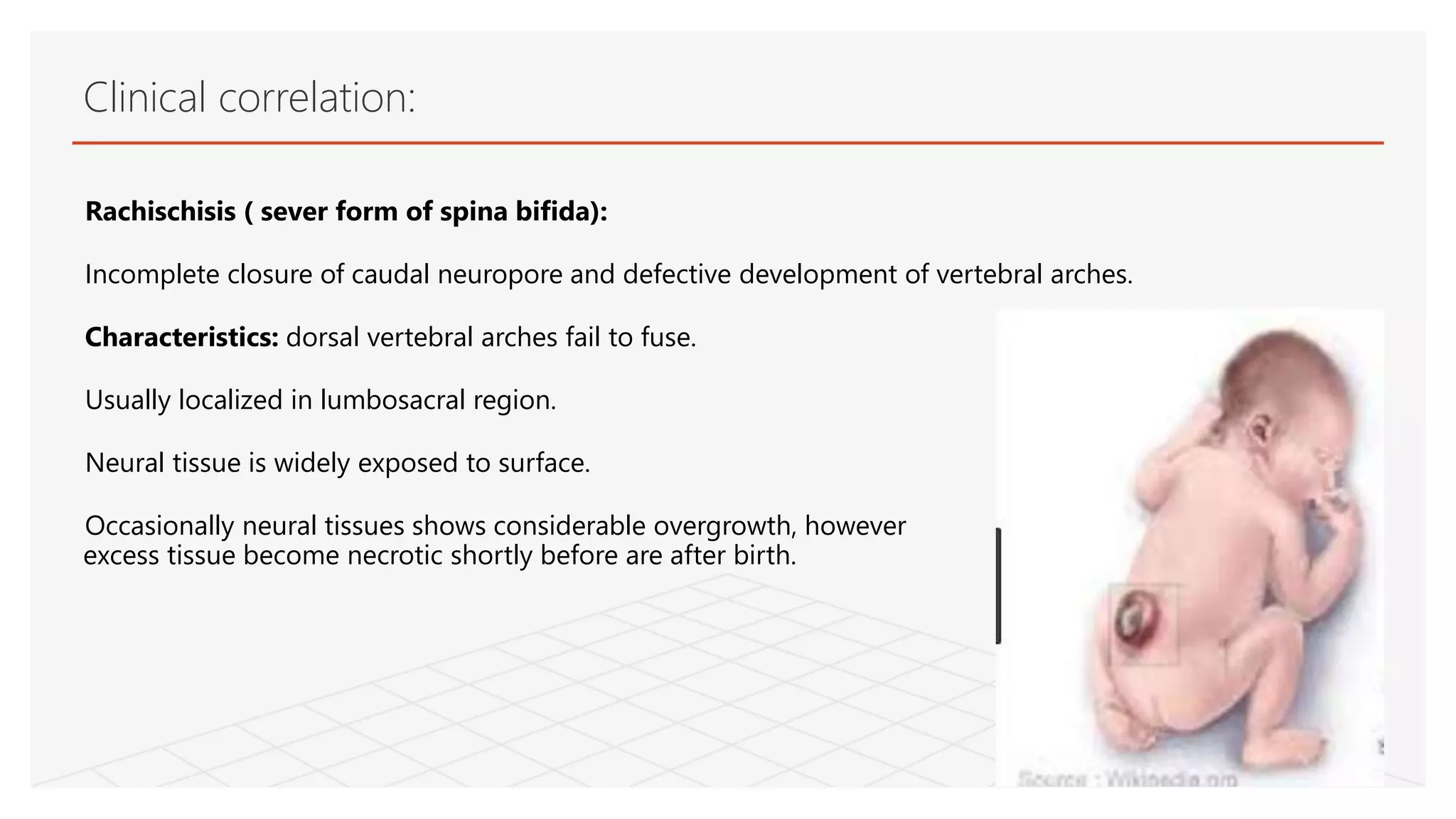 Rachischisis ( sever form of spina bifida):
Incomplete closure of caudal neuropore and defective development of vertebral arches.
Characteristics: dorsal vertebral arches fail to fuse.
Usually localized in lumbosacral region.
Neural tissue is widely exposed to surface.
Occasionally neural tissues shows considerable overgrowth, however
excess tissue become necrotic shortly before are after birth.
Clinical correlation:
 