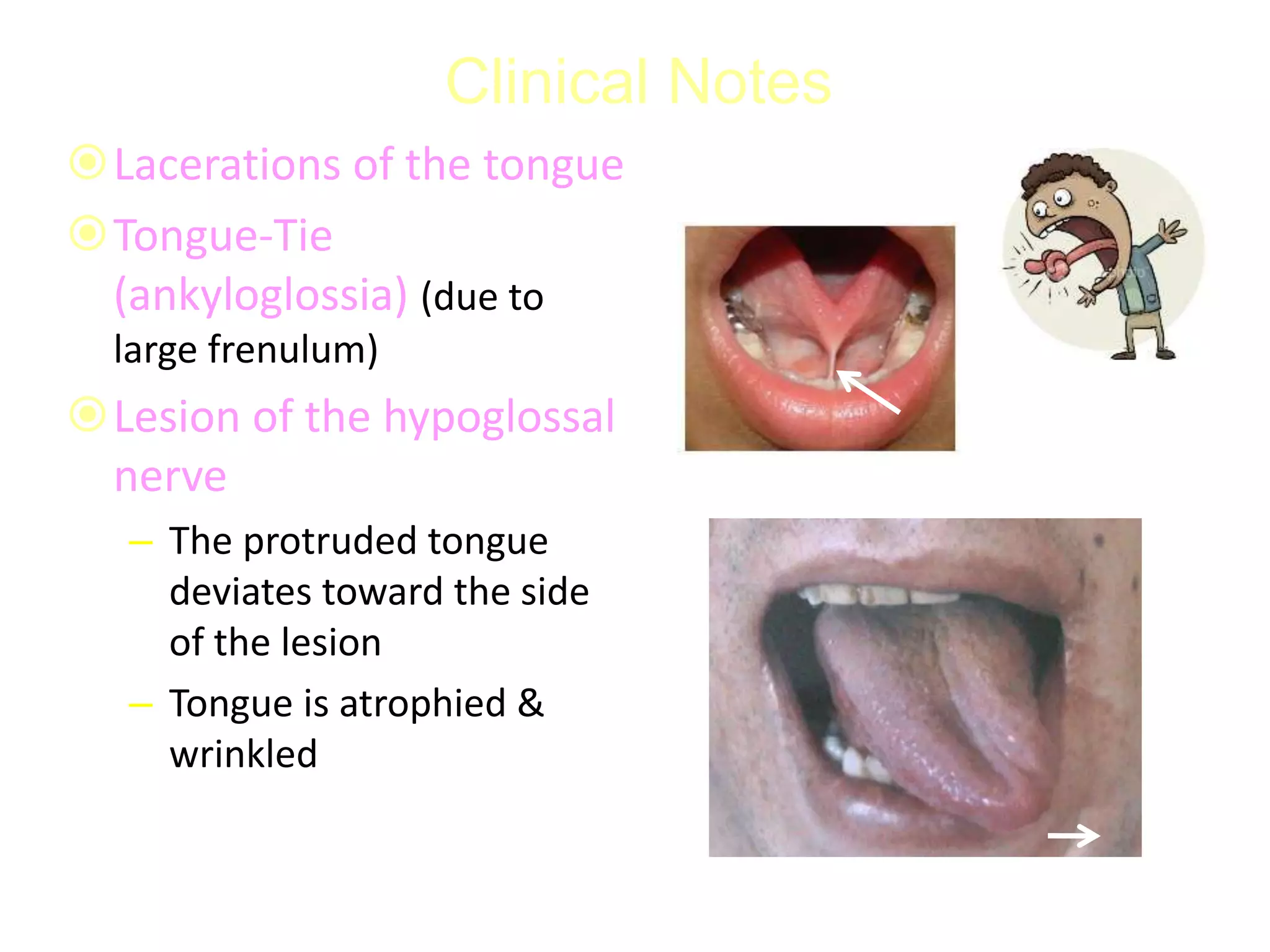Clinical Notes
Lacerations of the tongue
Tongue-Tie
(ankyloglossia) (due to
large frenulum)
Lesion of the hypoglossal
nerve
– The protruded tongue
deviates toward the side
of the lesion
– Tongue is atrophied &
wrinkled
 