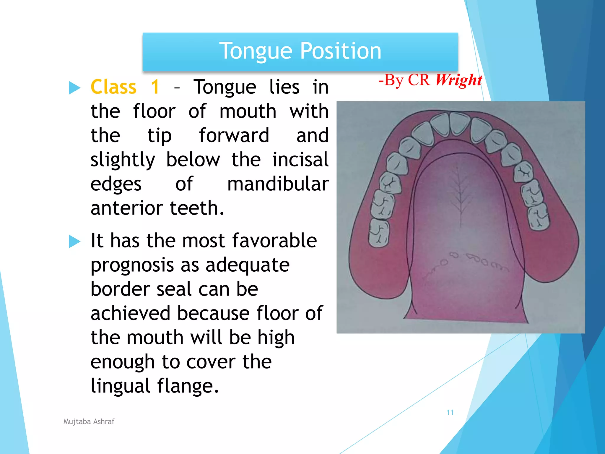 Development of tongue, Speech & Prosthodontic consideration | PPTX