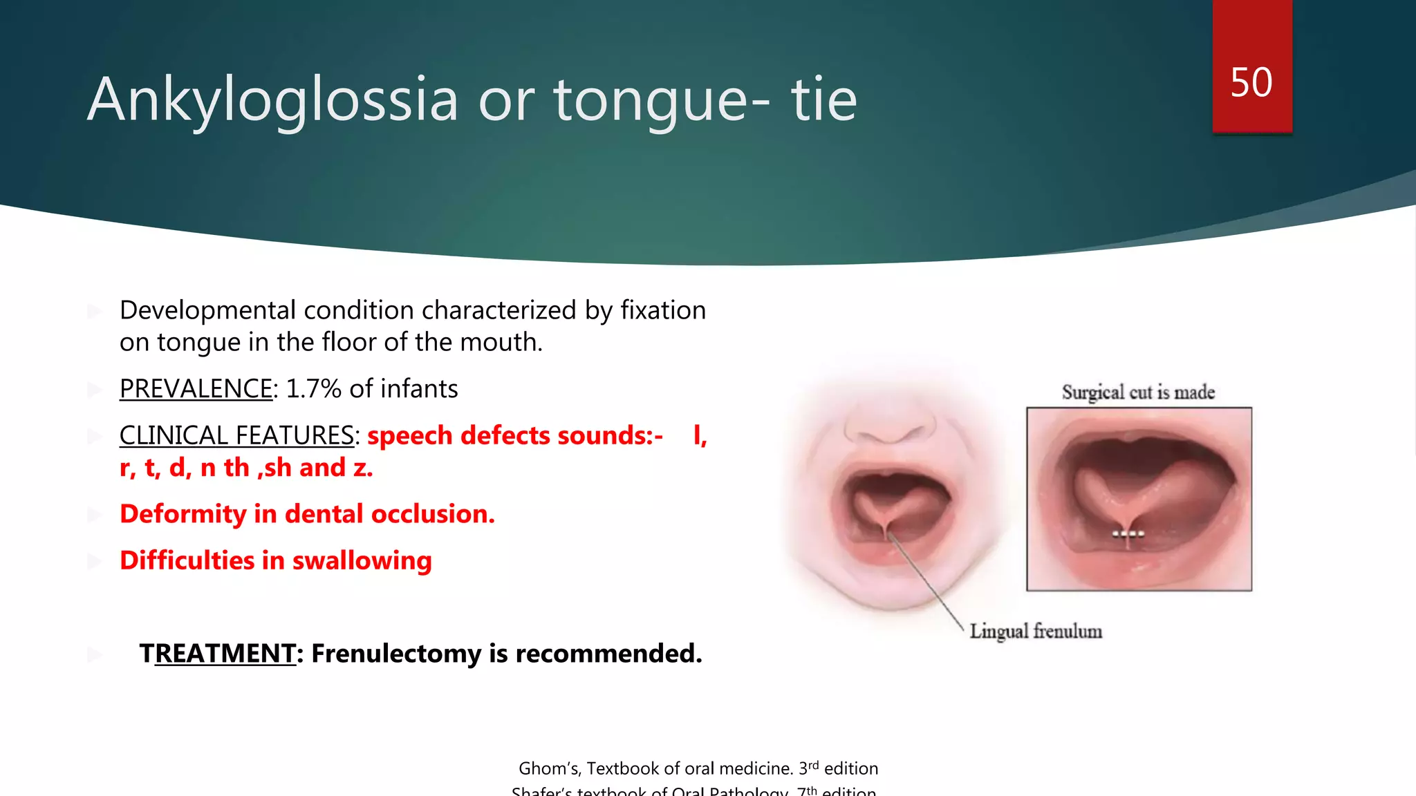 Ankyloglossia or tongue- tie 50
 Developmental condition characterized by fixation
on tongue in the floor of the mouth.
 PREVALENCE: 1.7% of infants
 CLINICAL FEATURES: speech defects sounds:- l,
r, t, d, n th ,sh and z.
 Deformity in dental occlusion.
 Difficulties in swallowing
 TREATMENT: Frenulectomy is recommended.
Ghom’s, Textbook of oral medicine. 3rd edition
th
 