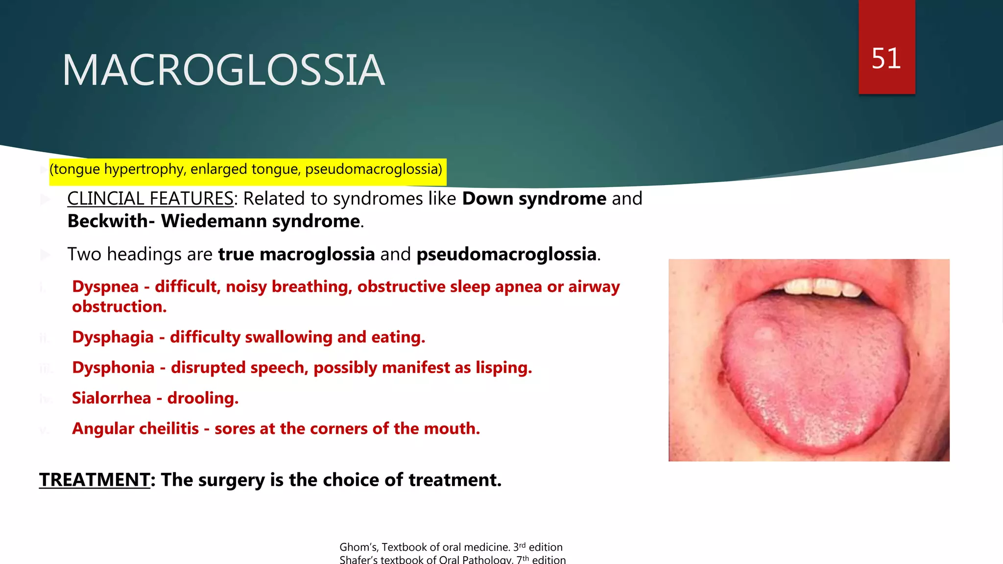 MACROGLOSSIA 51
(tongue hypertrophy, enlarged tongue, pseudomacroglossia)
 CLINCIAL FEATURES: Related to syndromes like Down syndrome and
Beckwith- Wiedemann syndrome.
 Two headings are true macroglossia and pseudomacroglossia.
i. Dyspnea - difficult, noisy breathing, obstructive sleep apnea or airway
obstruction.
ii. Dysphagia - difficulty swallowing and eating.
iii. Dysphonia - disrupted speech, possibly manifest as lisping.
iv. Sialorrhea - drooling.
v. Angular cheilitis - sores at the corners of the mouth.
TREATMENT: The surgery is the choice of treatment.
Ghom’s, Textbook of oral medicine. 3rd edition
Shafer’s textbook of Oral Pathology, 7th edition
 