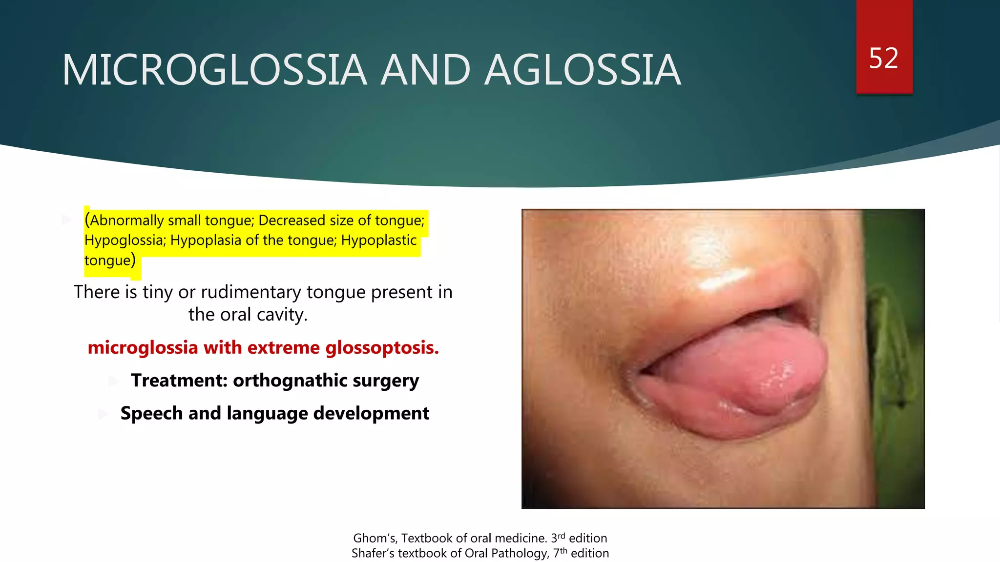 MICROGLOSSIA AND AGLOSSIA 52
 (Abnormally small tongue; Decreased size of tongue;
Hypoglossia; Hypoplasia of the tongue; Hypoplastic
tongue)
There is tiny or rudimentary tongue present in
the oral cavity.
microglossia with extreme glossoptosis.
 Treatment: orthognathic surgery
 Speech and language development
Ghom’s, Textbook of oral medicine. 3rd edition
Shafer’s textbook of Oral Pathology, 7th edition
 