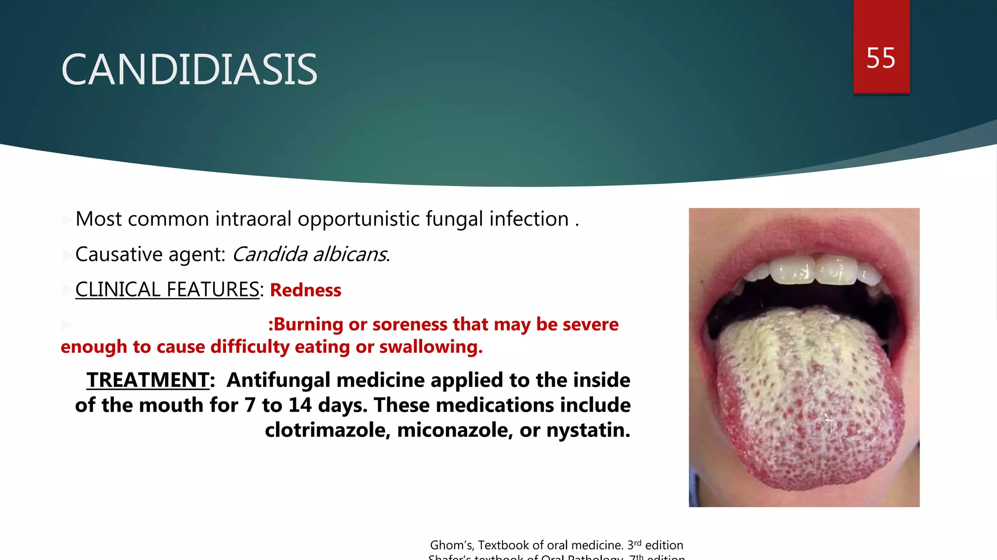 CANDIDIASIS 55
Most common intraoral opportunistic fungal infection .
Causative agent: Candida albicans.
CLINICAL FEATURES: Redness
 :Burning or soreness that may be severe
enough to cause difficulty eating or swallowing.
TREATMENT: Antifungal medicine applied to the inside
of the mouth for 7 to 14 days. These medications include
clotrimazole, miconazole, or nystatin.
Ghom’s, Textbook of oral medicine. 3rd edition
 