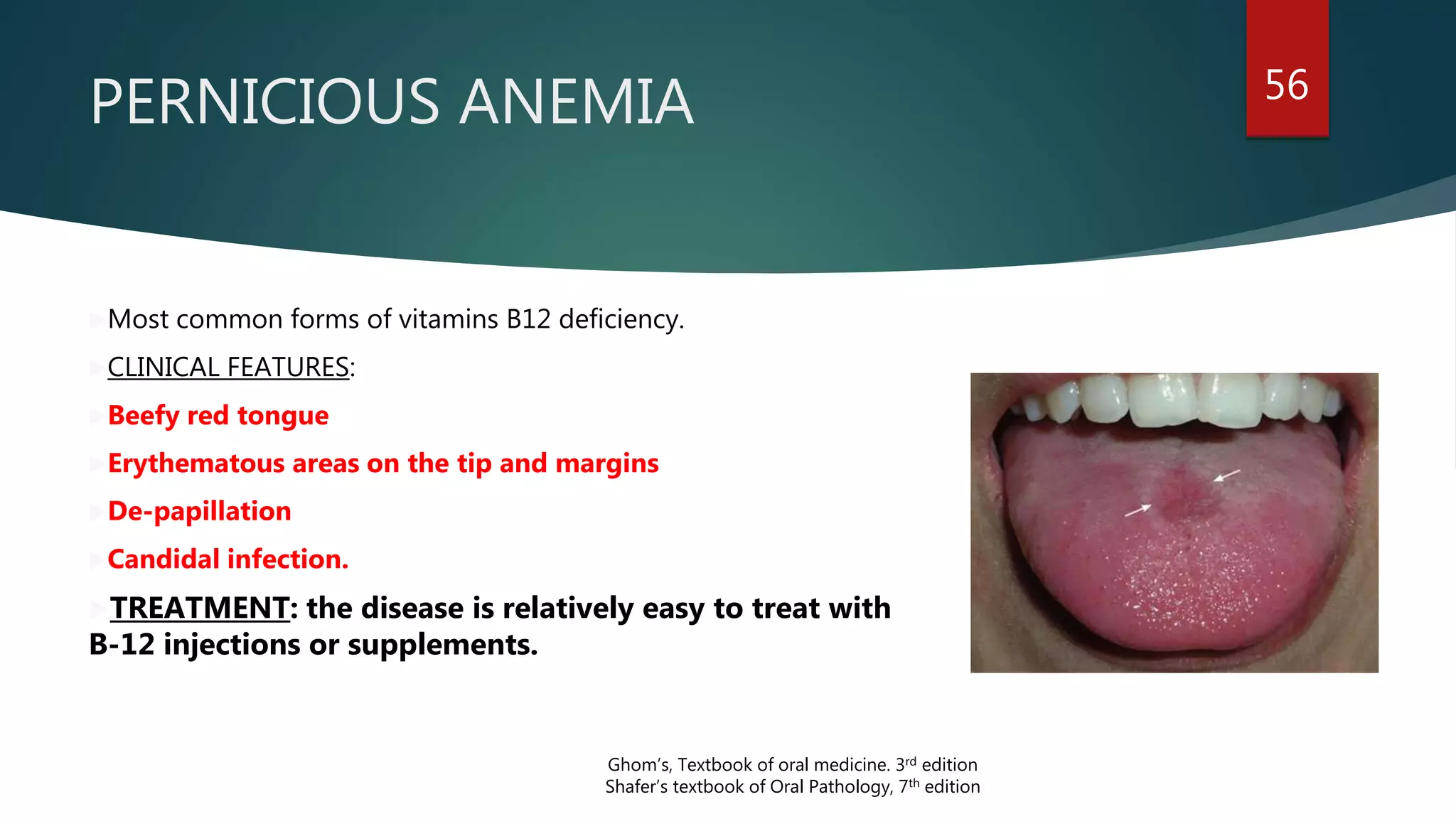 PERNICIOUS ANEMIA 56
Most common forms of vitamins B12 deficiency.
CLINICAL FEATURES:
Beefy red tongue
Erythematous areas on the tip and margins
De-papillation
Candidal infection.
TREATMENT: the disease is relatively easy to treat with
B-12 injections or supplements.
Ghom’s, Textbook of oral medicine. 3rd edition
Shafer’s textbook of Oral Pathology, 7th edition
 