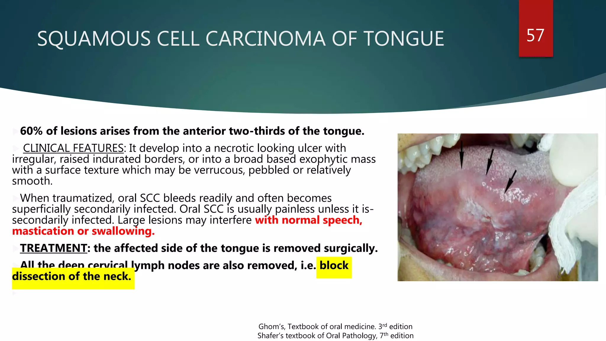 SQUAMOUS CELL CARCINOMA OF TONGUE 57
60% of lesions arises from the anterior two-thirds of the tongue.
 CLINICAL FEATURES: It develop into a necrotic looking ulcer with
irregular, raised indurated borders, or into a broad based exophytic mass
with a surface texture which may be verrucous, pebbled or relatively
smooth.
When traumatized, oral SCC bleeds readily and often becomes
superficially secondarily infected. Oral SCC is usually painless unless it is-
secondarily infected. Large lesions may interfere with normal speech,
mastication or swallowing.
TREATMENT: the affected side of the tongue is removed surgically.
All the deep cervical lymph nodes are also removed, i.e. block
dissection of the neck.

Ghom’s, Textbook of oral medicine. 3rd edition
Shafer’s textbook of Oral Pathology, 7th edition
 