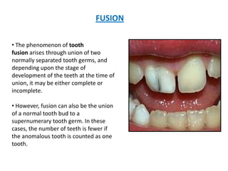 FUSION
• The phenomenon of tooth
fusion arises through union of two
normally separated tooth germs, and
depending upon the stage of
development of the teeth at the time of
union, it may be either complete or
incomplete.
• However, fusion can also be the union
of a normal tooth bud to a
supernumerary tooth germ. In these
cases, the number of teeth is fewer if
the anomalous tooth is counted as one
tooth.
 