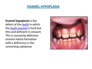 ENAMEL HYPOPLASIA
Enamel hypoplasia is the
defect of the teeth in which
the tooth enamel is hard but
thin and deficient in amount
This is caused by defective
enamel matrix formation
with a deficiency in the
cementing substance
 