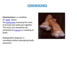 CONCRESCENCE
Concrescence is a condition
of teeth where
the cementum overlying the roots
of at least two teeth join together.
The cause can sometimes be
attributed to trauma or crowding of
teeth.
Radiographic diagnosis is
mandatory before attempting tooth
extraction
 