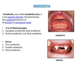 ANODONTIA

• Anodontia, also called anodontia vera, is
a rare genetic disorder characterized by
the congenital absence of
all primary or permanent teeth

• It is of following types
1. Complete anodontia/ total anodontia
2. Partial anodontia/ sub-Total anodontia
                                              COMPLETE


•    Forms-
1.   True anodontia
2.   Psuedo anodontia
3.   False anodontia



                                              PARTIAL
 