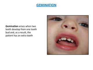 GEMINATION




Gemination arises when two
teeth develop from one tooth
bud and, as a result, the
patient has an extra tooth
 