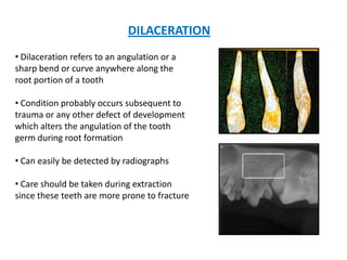 DILACERATION
• Dilaceration refers to an angulation or a
sharp bend or curve anywhere along the
root portion of a tooth

• Condition probably occurs subsequent to
trauma or any other defect of development
which alters the angulation of the tooth
germ during root formation

• Can easily be detected by radiographs

• Care should be taken during extraction
since these teeth are more prone to fracture
 