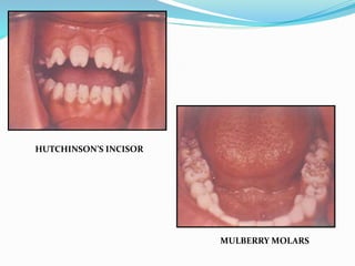 HUTCHINSON’S INCISOR 
MULBERRY MOLARS 
 