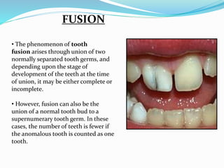 FUSION
• The phenomenon of tooth
fusion arises through union of two
normally separated tooth germs, and
depending upon the stage of
development of the teeth at the time
of union, it may be either complete or
incomplete.
• However, fusion can also be the
union of a normal tooth bud to a
supernumerary tooth germ. In these
cases, the number of teeth is fewer if
the anomalous tooth is counted as one
tooth.
 