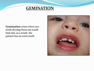 GEMINATION
Gemination arises when two
teeth develop from one tooth
bud and, as a result, the
patient has an extra tooth
 