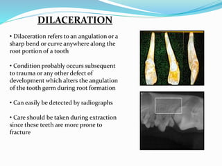 DILACERATION
• Dilaceration refers to an angulation or a
sharp bend or curve anywhere along the
root portion of a tooth
• Condition probably occurs subsequent
to trauma or any other defect of
development which alters the angulation
of the tooth germ during root formation
• Can easily be detected by radiographs
• Care should be taken during extraction
since these teeth are more prone to
fracture
 