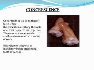 CONCRESCENCE
Concrescence is a condition of
teeth where
the cementum overlying the roots
of at least two teeth join together.
The cause can sometimes be
attributed to trauma or crowding
of teeth.
Radiographic diagnosis is
mandatory before attempting
tooth extraction
 