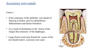 Accessory root canals
Causes :-
• If the continuity of the epithelial root sheath of
Hertwig is broken prior to odontoblastic
differentiation and dentin formation
• As a result of disturbance in the fusion of the
tongue like extension of the diaphragm.
• Large blood vessel may disturb the course of the
root sheath lead to accessory root canal.
 