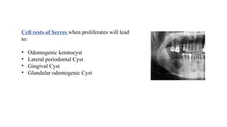 Cell rests of Serres when proliferates will lead
to:
• Odontogenic keratocyst
• Lateral periodontal Cyst
• Gingival Cyst
• Glandular odontogenic Cyst
 