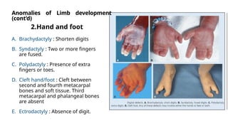 Development of Upper Limb: clear, systematic overview of the ...