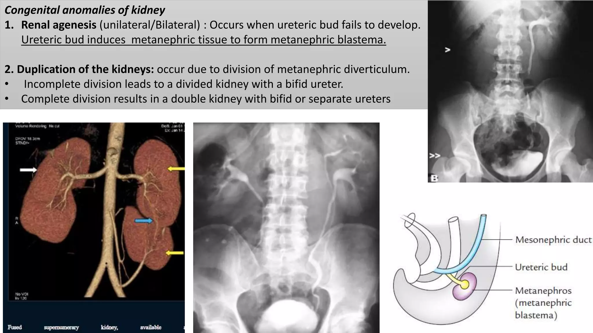 Congenital anomalies of kidney
1. Renal agenesis (unilateral/Bilateral) : Occurs when ureteric bud fails to develop.
Ureteric bud induces metanephric tissue to form metanephric blastema.
2. Duplication of the kidneys: occur due to division of metanephric diverticulum.
• Incomplete division leads to a divided kidney with a bifid ureter.
• Complete division results in a double kidney with bifid or separate ureters
 