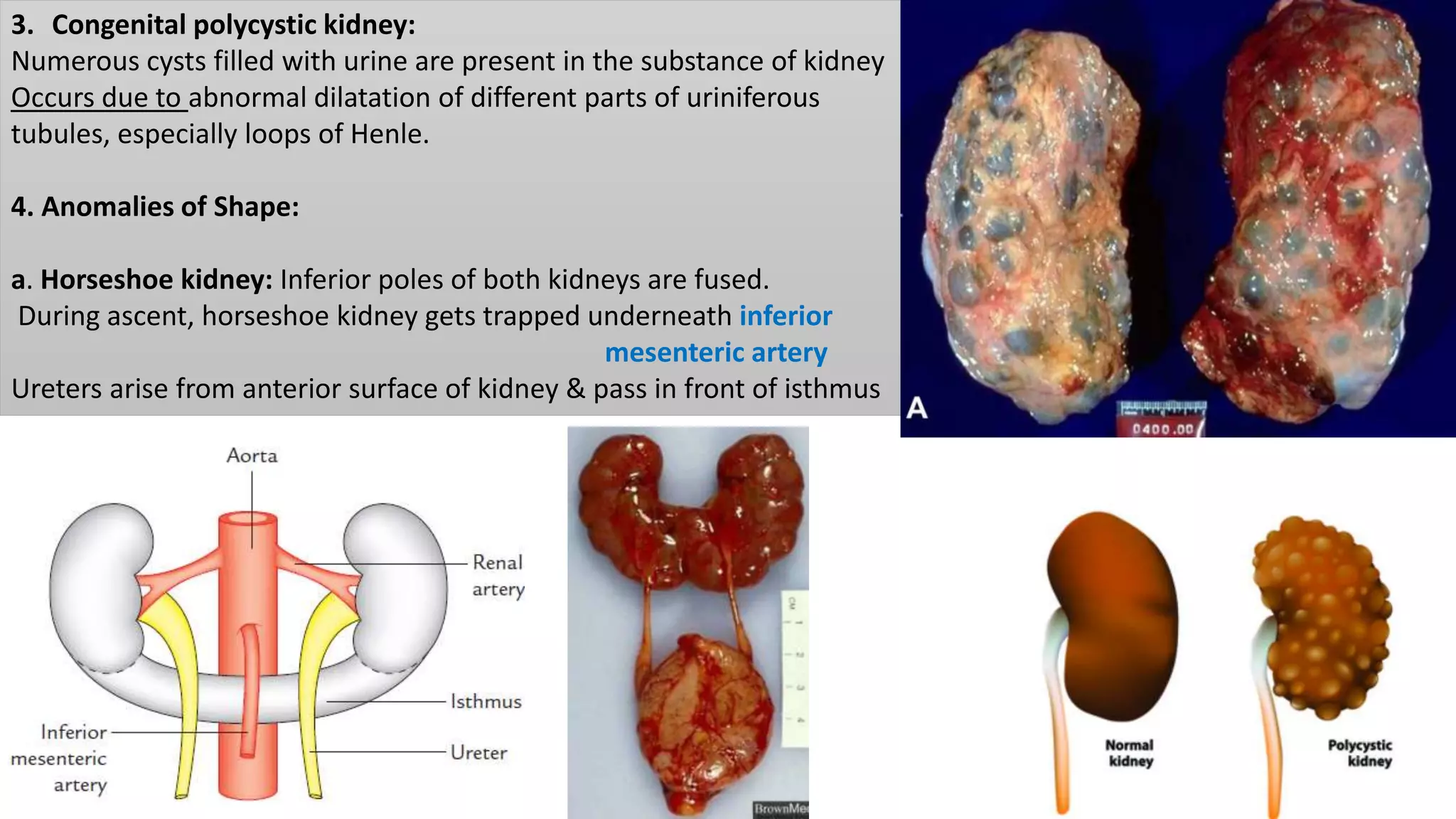 3. Congenital polycystic kidney:
Numerous cysts filled with urine are present in the substance of kidney
Occurs due to abnormal dilatation of different parts of uriniferous
tubules, especially loops of Henle.
4. Anomalies of Shape:
a. Horseshoe kidney: Inferior poles of both kidneys are fused.
During ascent, horseshoe kidney gets trapped underneath inferior
mesenteric artery
Ureters arise from anterior surface of kidney & pass in front of isthmus
 