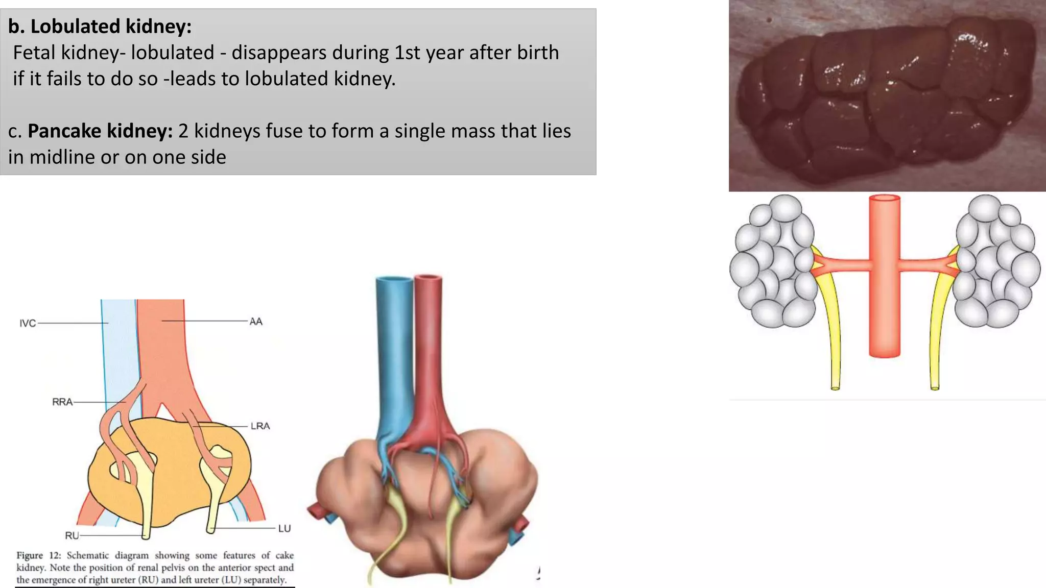 b. Lobulated kidney:
Fetal kidney- lobulated - disappears during 1st year after birth
if it fails to do so -leads to lobulated kidney.
c. Pancake kidney: 2 kidneys fuse to form a single mass that lies
in midline or on one side
 