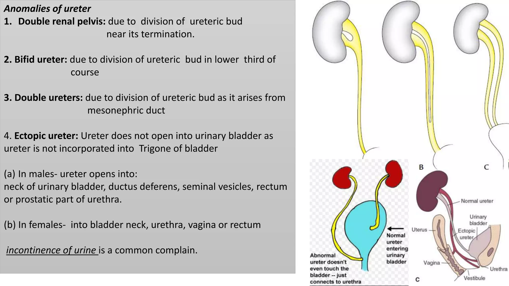 Anomalies of ureter
1. Double renal pelvis: due to division of ureteric bud
near its termination.
2. Bifid ureter: due to division of ureteric bud in lower third of
course
3. Double ureters: due to division of ureteric bud as it arises from
mesonephric duct
4. Ectopic ureter: Ureter does not open into urinary bladder as
ureter is not incorporated into Trigone of bladder
(a) In males- ureter opens into:
neck of urinary bladder, ductus deferens, seminal vesicles, rectum
or prostatic part of urethra.
(b) In females- into bladder neck, urethra, vagina or rectum
incontinence of urine is a common complain.
 